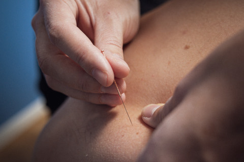 DRY NEEDLING